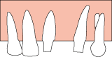 Implantat