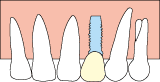 Implantat