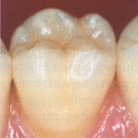 Corona de ZIRCONIO