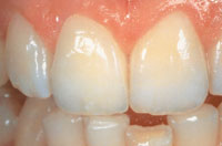 Healthy gums