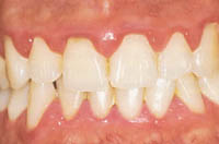 Healthy gums